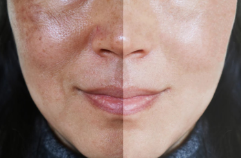 How can you shrink large pores?